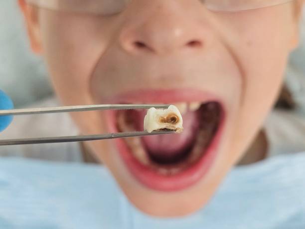 Best Broken or Cracked Tooth Emergency Dentist in Conyngham, PA